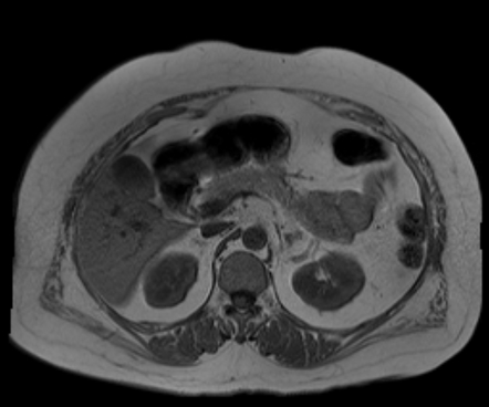 Normal upper abdominal MRI | Radiology Case | Radiopaedia.org