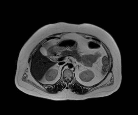 Normal upper abdominal MRI | Image | Radiopaedia.org