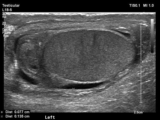 Torsion Of The Hydatid Of Morgagni Testicular Appendix Image