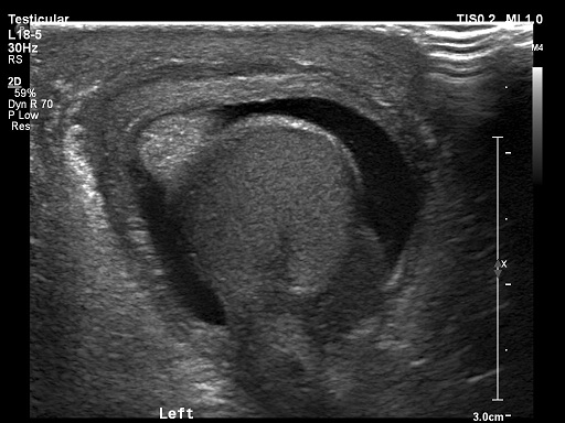 Torsion Of The Hydatid Of Morgagni Testicular Appendix Image