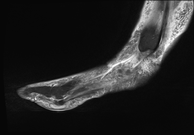 Adventitious Bursitis | Image | Radiopaedia.org