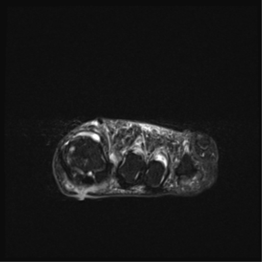 Adventitious Bursitis | Image | Radiopaedia.org