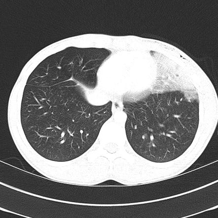 Pulmonary Contusion | Radiology Reference Article | Radiopaedia.org