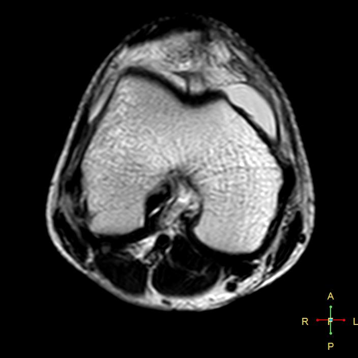 Patellar dislocation with trochlear dysplasia | Image | Radiopaedia.org