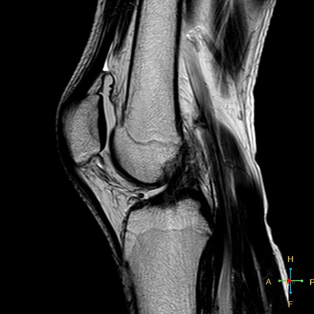 Patellar dislocation with trochlear dysplasia | Image | Radiopaedia.org