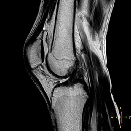 Patellar Dislocation With Trochlear Dysplasia 