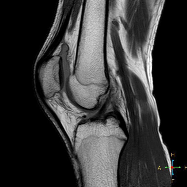 acute patellar subluxation