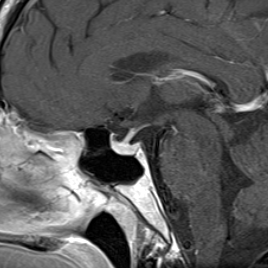 Posterior Pituitary Bright Spot Normal Image