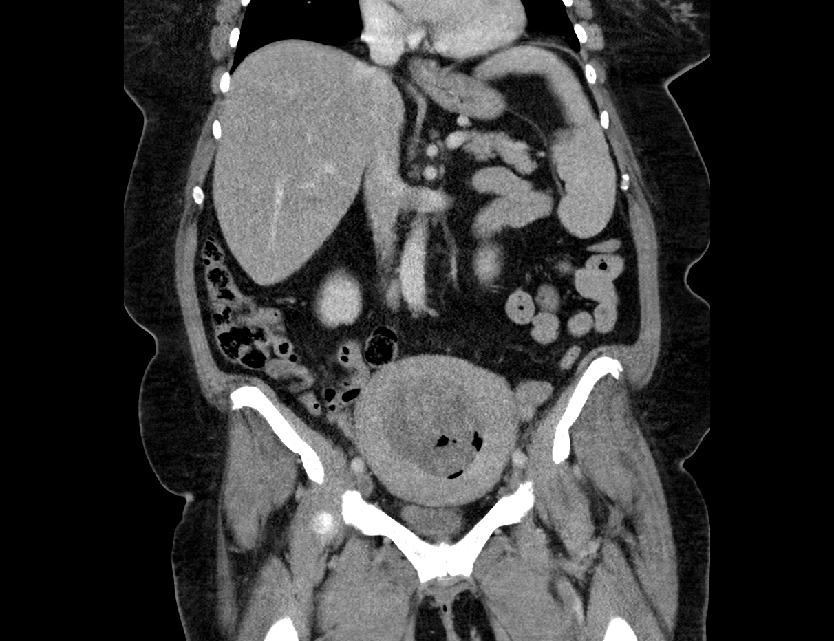 What Is A Mixed Mullerian Tumor