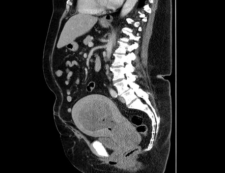 Malignant mixed Mullerian tumor of the uterus | Radiology Reference ...