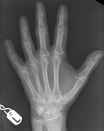 Healing ring and little finger proximal phalanx fractures | Image ...