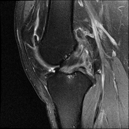 Secondary osteochrondromatosis | Image | Radiopaedia.org