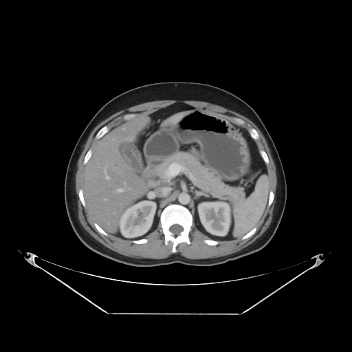 Acute complicated calculous cholecystitis | Image | Radiopaedia.org