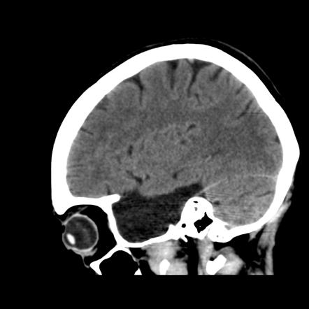 Arachnoid cyst | Image | Radiopaedia.org