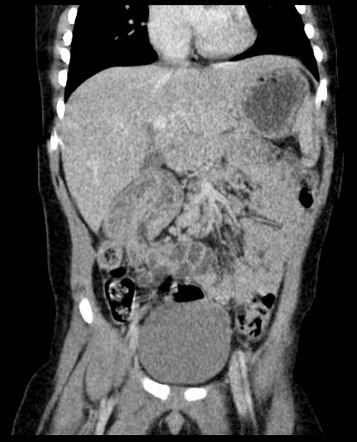 Ileocolic intussusception | Image | Radiopaedia.org