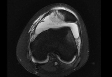 Osteochondral Fracture 