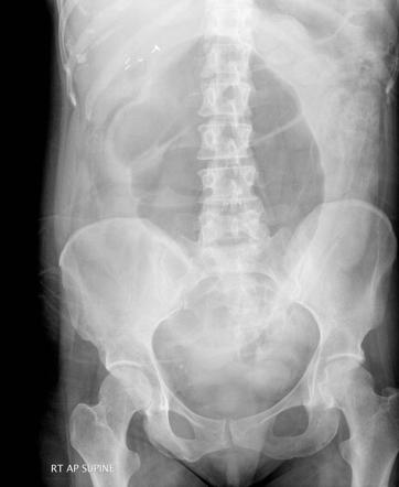 Caecal Volvulus Radiology Reference Article Radiopaedia Org