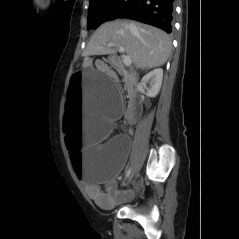 Cecal Volvulus Image