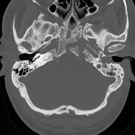 Skull base osteomyelitis | Image | Radiopaedia.org