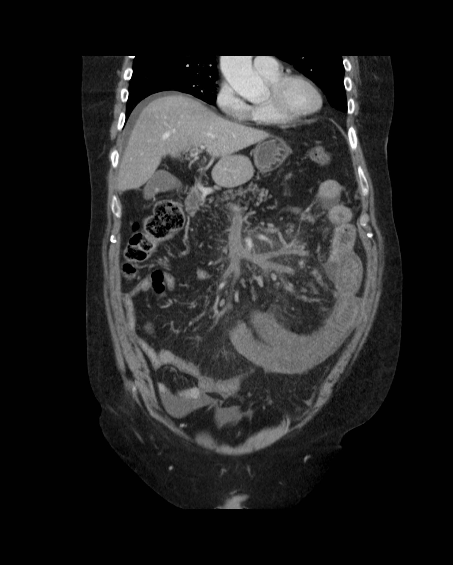 Mesenteric Venous Thrombosis And Small Bowel Ischemia | Image ...