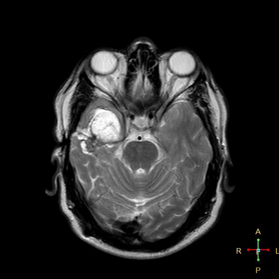 Ruptured Intracranial Dermoid Cyst Image 1738