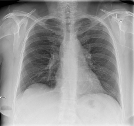 Breast abscess | Radiology Case | Radiopaedia.org