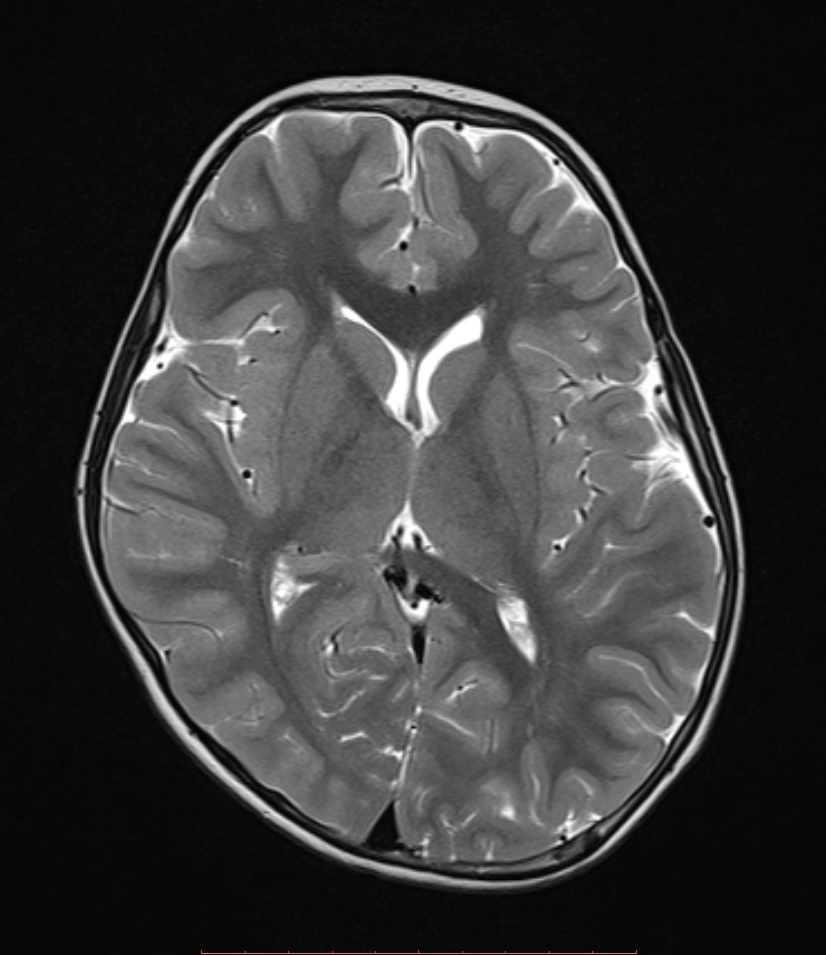 Positional plagiocephaly (MRI) | Image | Radiopaedia.org