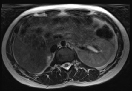 Lying down adrenal sign | Radiology Reference Article | Radiopaedia.org