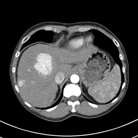 Hepatocellular carcinoma | Radiology Reference Article | Radiopaedia.org