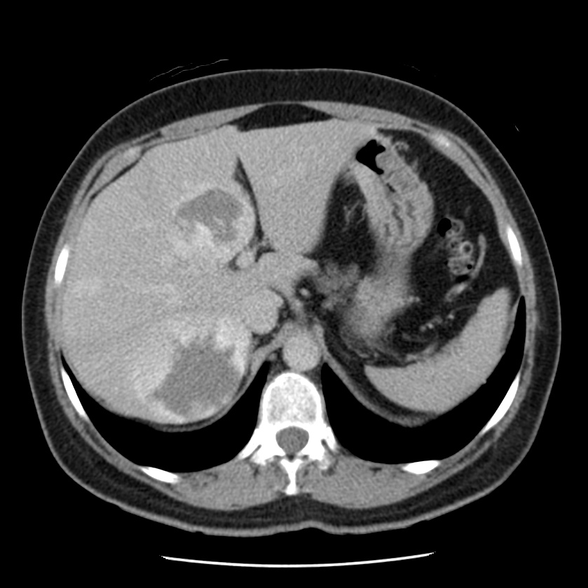 Multiple hepatic hemangiomas | Image | Radiopaedia.org