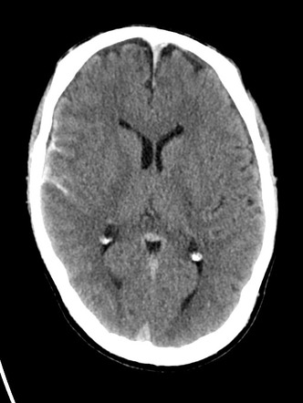 Traumatic subarachnoid and subdural hygroma | Radiology Case ...