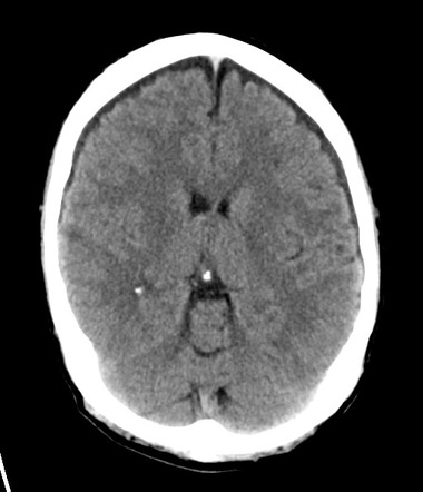 Subdural hygroma | Radiology Reference Article | Radiopaedia.org