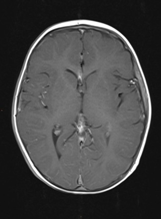 Focal cortical dysplasia (type I) | Image | Radiopaedia.org