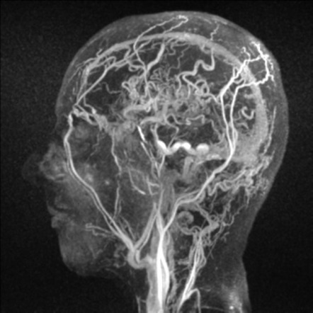 Dural arteriovenous fistula (dAVF) - progression from normal to marked ...