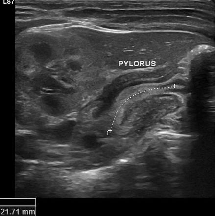 Pyloric Stenosis Radiology Case Radiopaedia Org