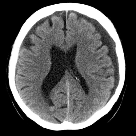 subdural hygroma icd 10