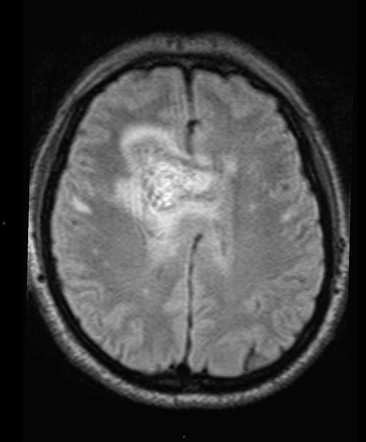 Glioblastoma (IDH wild-type) | Image | Radiopaedia.org