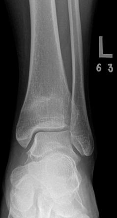 stress fracture x ray tibia