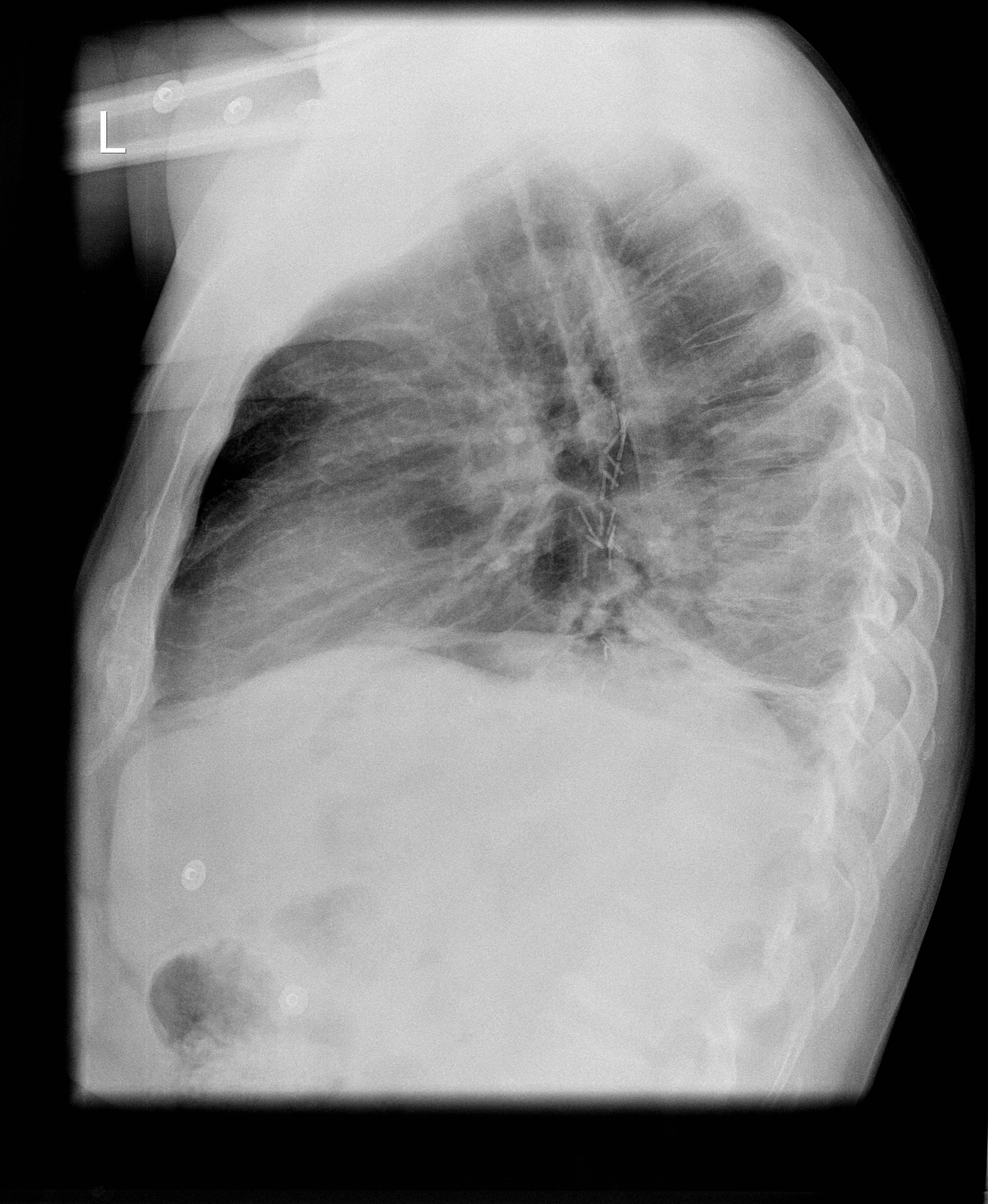 Gastric pull up simulating air space opacification | Image ...