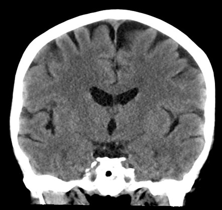 Posterior reversible encephalopathy syndrome (PRES) | Image ...