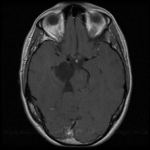 Epidermoid Cyst Cerebellopontine Angle Image 5348