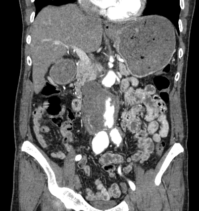 Chronic contained rupture of abdominal aortic aneurysm with extensive ...