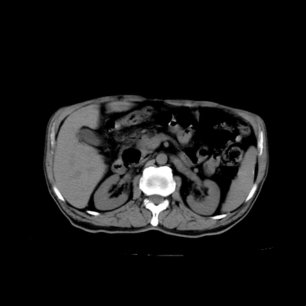 Mesenteric carcinoid tumor | Radiology Case | Radiopaedia.org