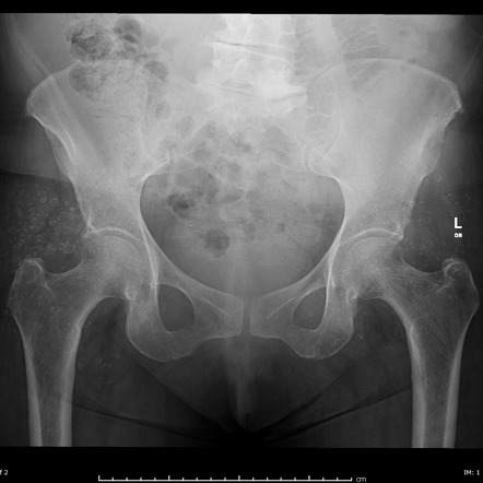 Soft tissue calcifications - hip | Image | Radiopaedia.org