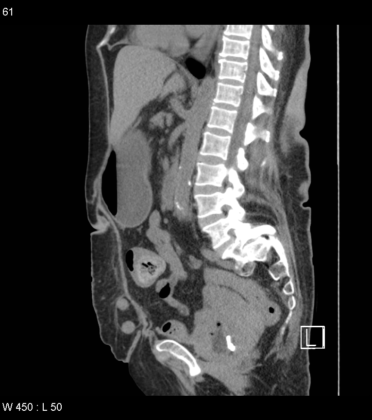 Bouveret syndrome | Image | Radiopaedia.org