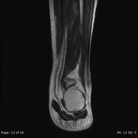 Posterior Ankle Impingement (os Trigonum) Syndrome | Image ...