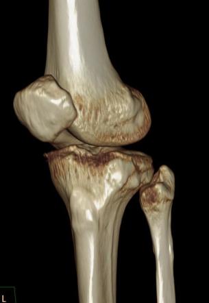 Segond and reverse Segond fractures | Image | Radiopaedia.org