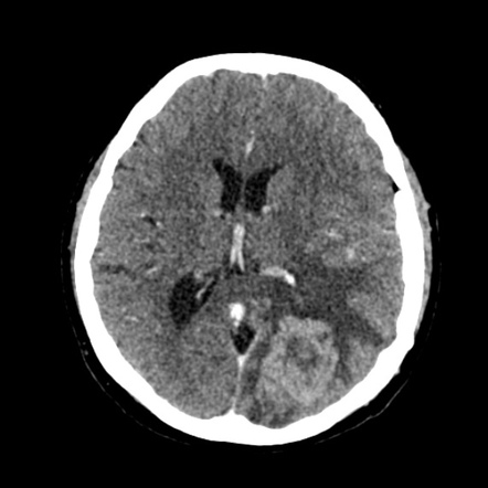 Cerebral metastases | Image | Radiopaedia.org