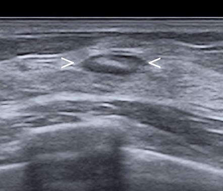 Intramammary Lymph Node 