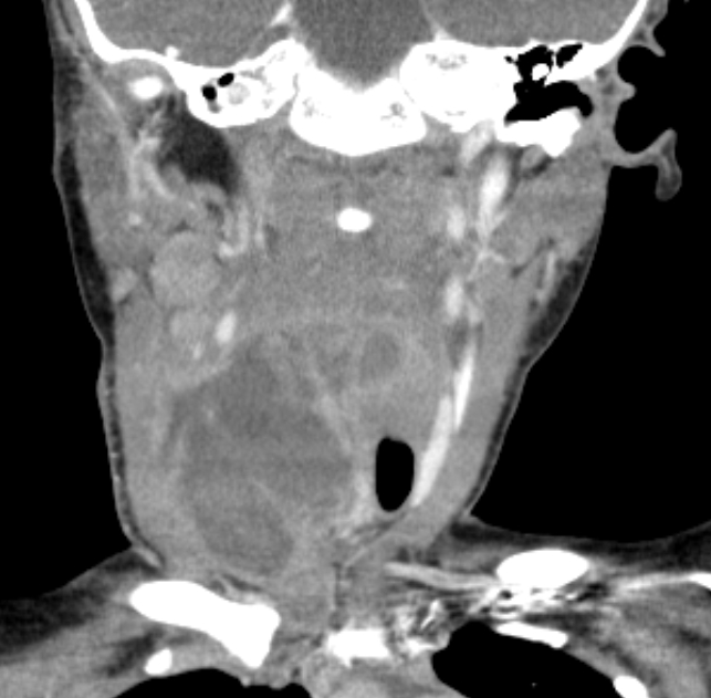 Infected 4th Branchial Cleft Cyst Image 0304